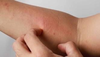 Arm mit Neurodermitis