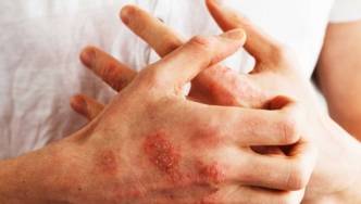 Hand mit Schuppenpflechte